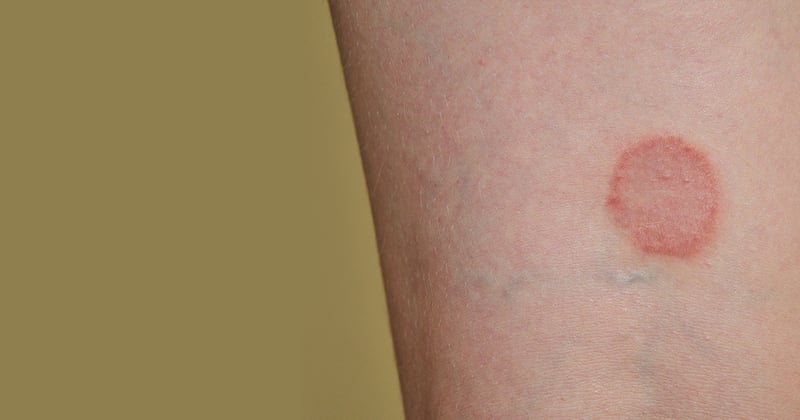 Ringworm Treatment Options: What is Ringworm Treatment? - Forefront  Dermatology