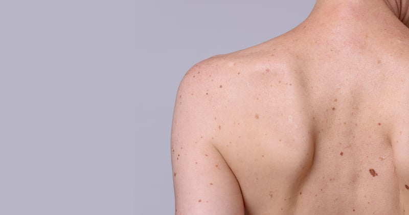 Seborrheic Keratosis Treatment Options What Is Seborrheic Keratosis Treatment Forefront 