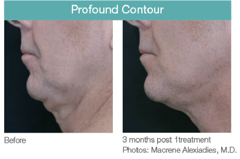 Profound Contour Before and After