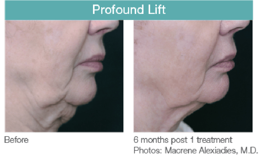 Profound Lift Before and After