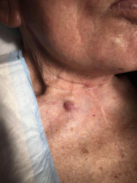A 94 y.o. male presents a nodule on the right anterior neck, present for two years and growing