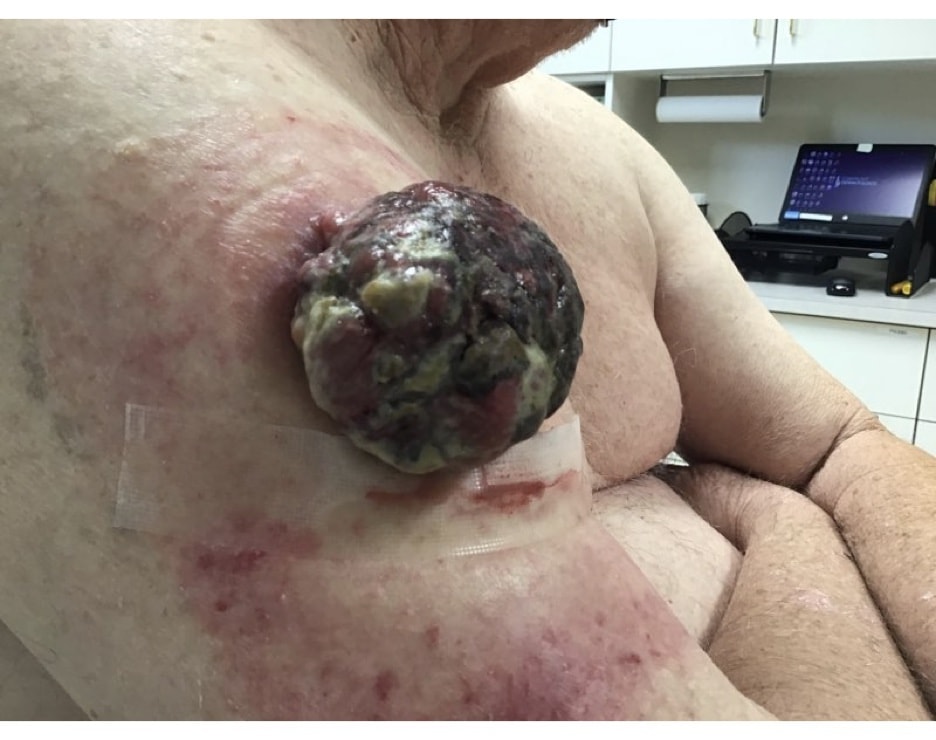 A 70+ year old male presents with a growing lesion located on the right upper arm