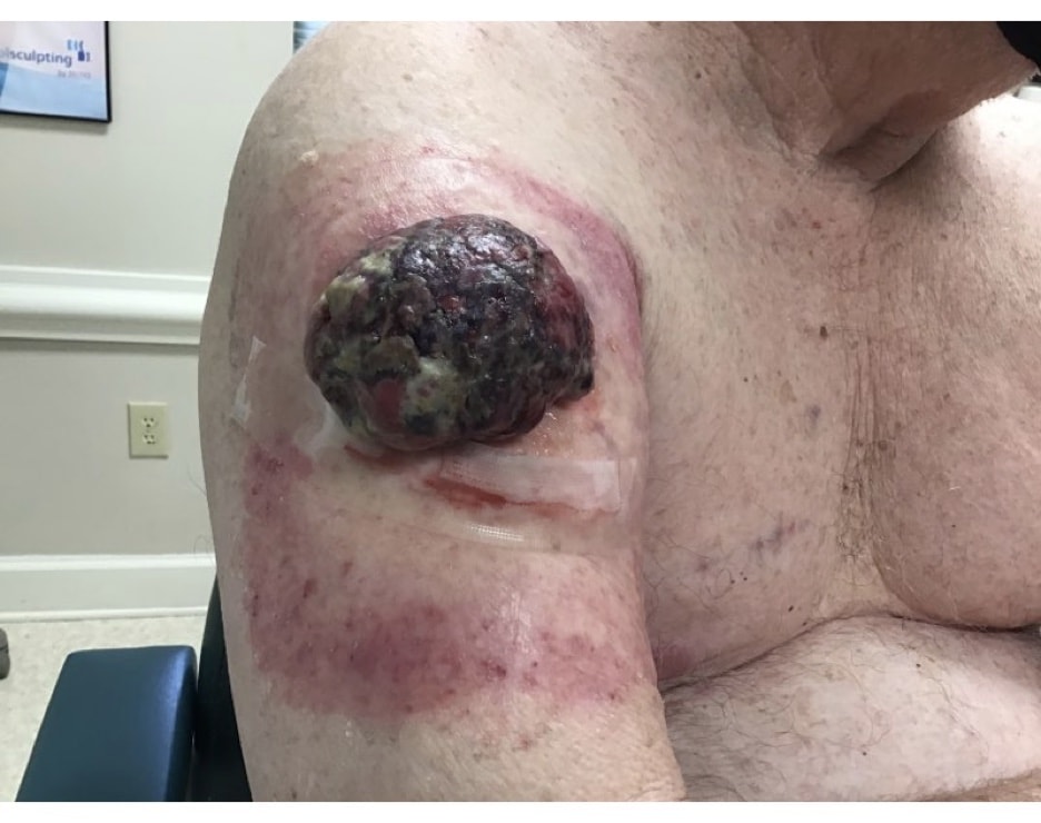 A 70+ year old male presents with a growing lesion located on the right upper arm