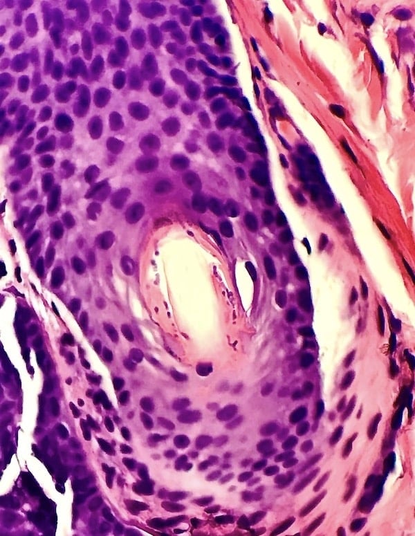 Nummular eczema Closeup