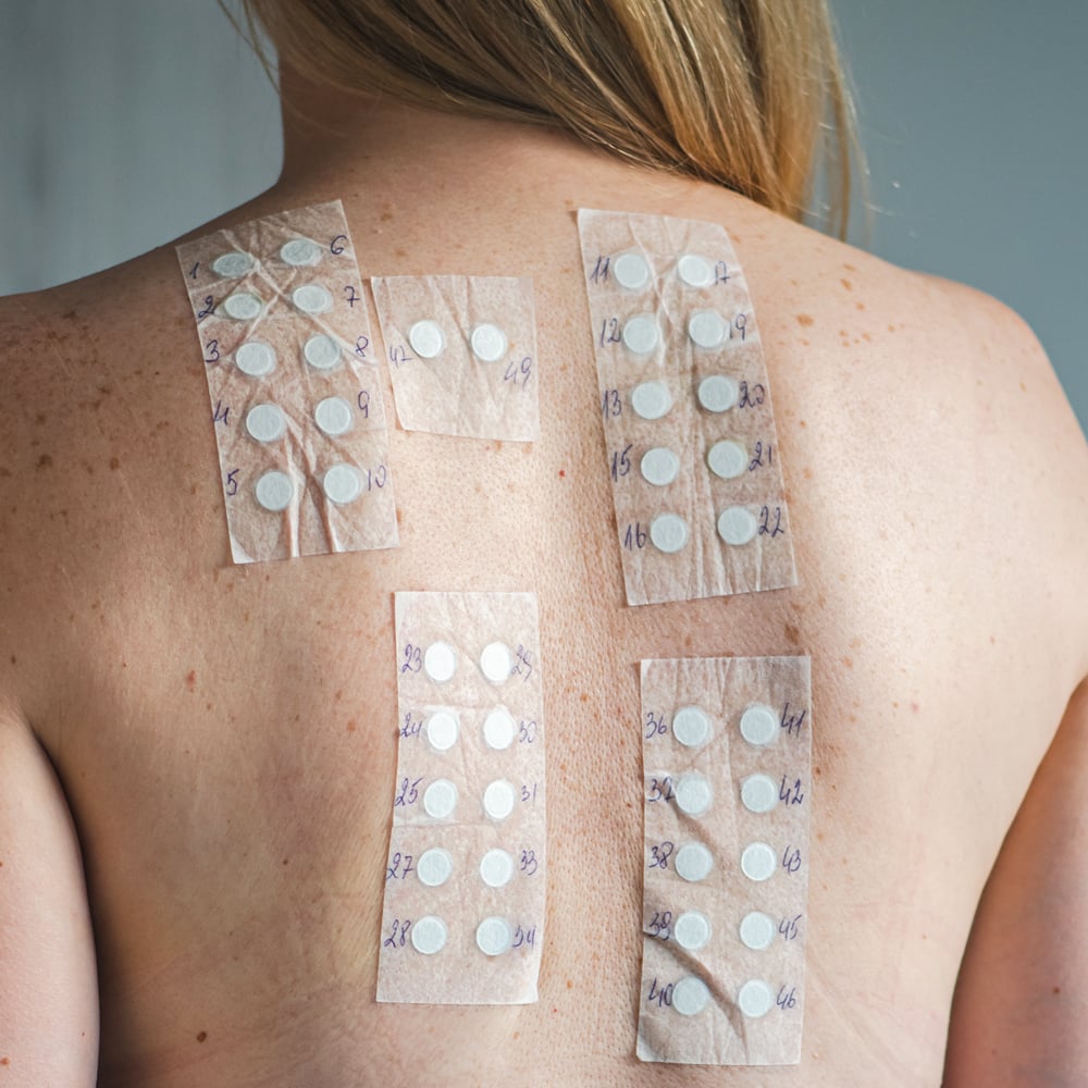 Patch Testing for Skin Allergies | Forefront Dermatology