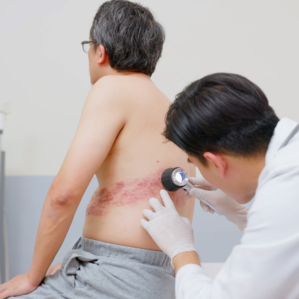 can glp 1 cause shingles What Does Look Like? Rash Stages With Pictures Is It Shingles or Something