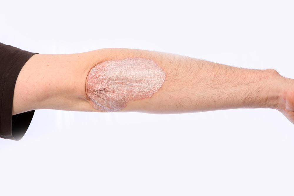 How to Treat Psoriasis - Explained By Dermatologist