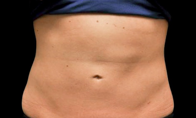 CoolSculpting on Back Fat Colorado Springs - Remove Back Fat