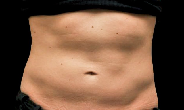 CoolSculpting Before