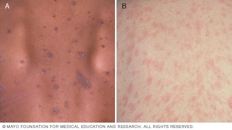 Pityriasis rosea - NHS