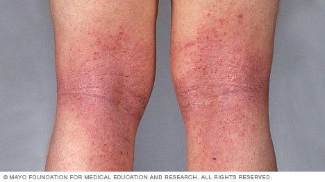 mild heat rash legs