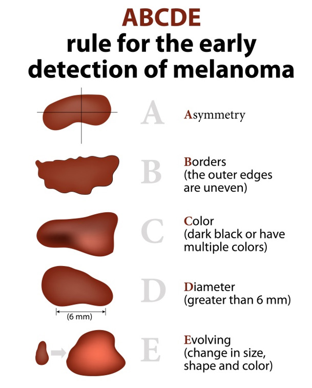 How To Perform A Self Skin Check Forefront Dermatology