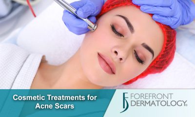 Cosmetic Treatments for Acne Scarring