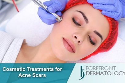 Cosmetic Treatments for Acne Scarring