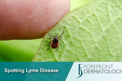 Lyme Disease and Your Skin