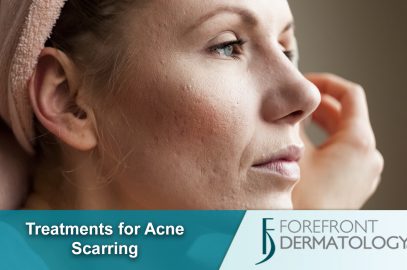 Treatments for Acne Scarring