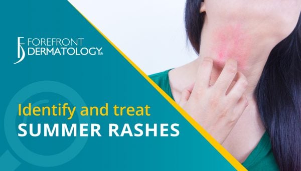 How to Identify and Treat Summer Skin Rashes