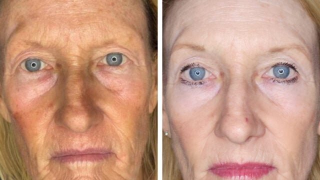 Before and after Fraxel with Platelet Rich Plasma (PRP)