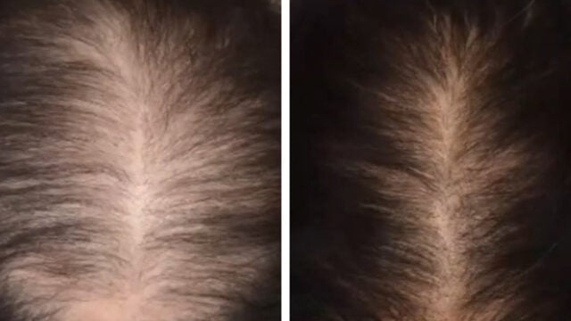 Before and after treatment of 3 Pre-Platelet Rich Plasma (PRP)