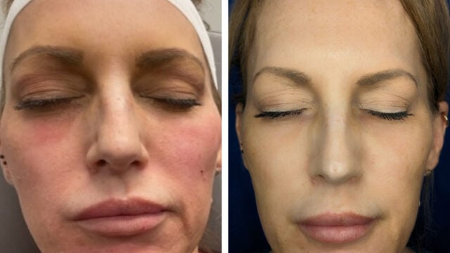 Before and after Juvederm Voluma and Volux