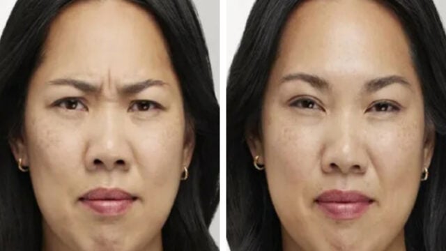 Before and after Botox for frown line