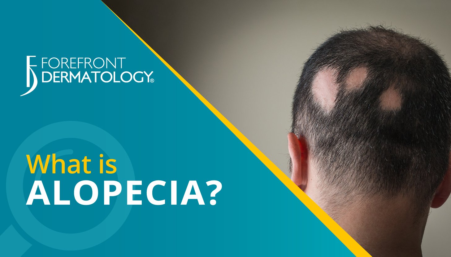 What is Alopecia? - Forefront Dermatology