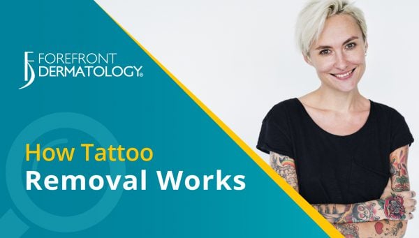 How Tattoo Removal Works
