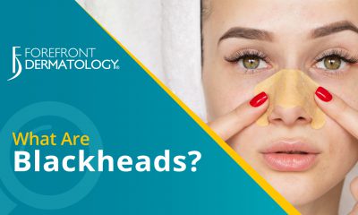 What are Blackheads?