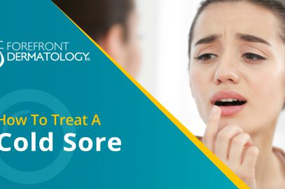 How to Treat a Cold Sore
