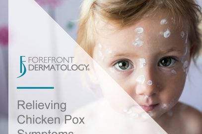 Relieving Chicken Pox Symptoms