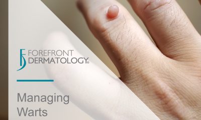 Managing Warts
