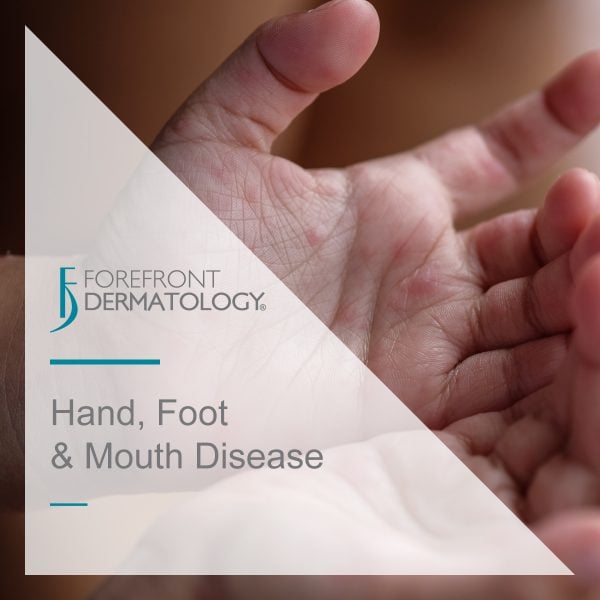 Hand, Foot and Mouth Disease: What You Need to Know