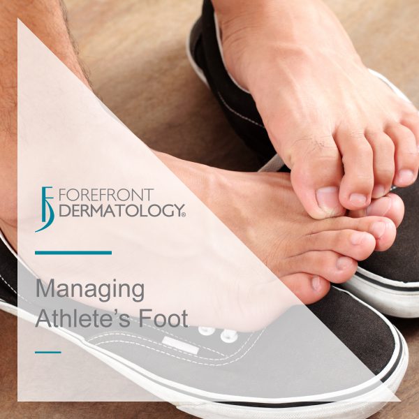 Managing Athlete’s Foot