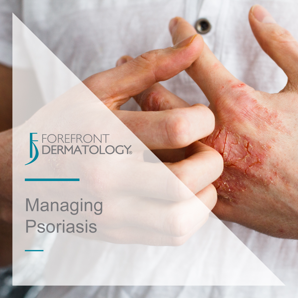 Managing Psoriasis Forefront Dermatology