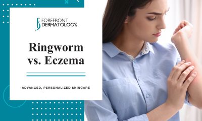 Ringworm Vs Eczema