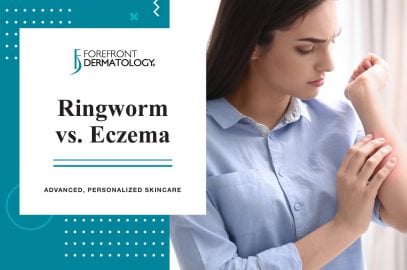Ringworm Vs Eczema