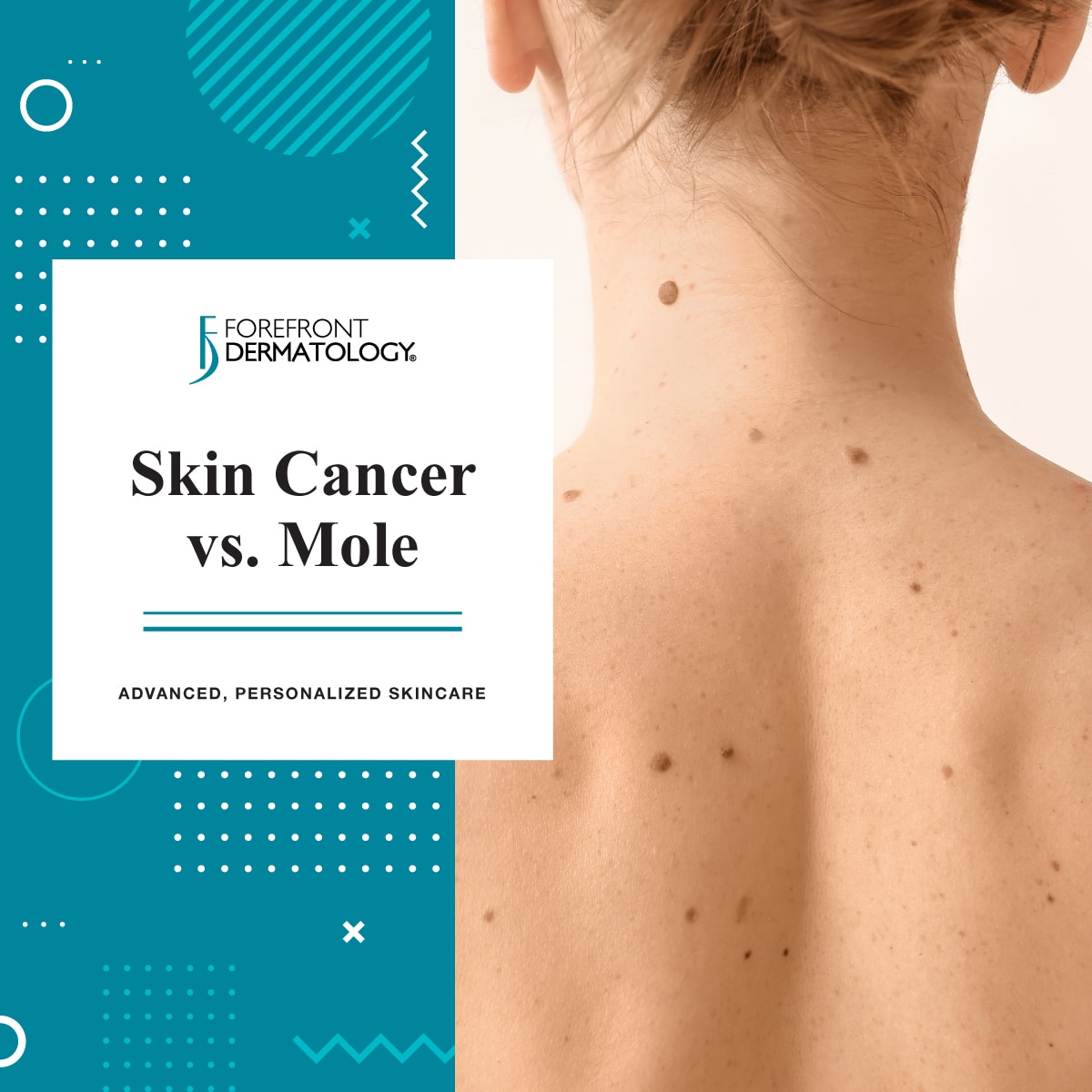 skin moles to worry about