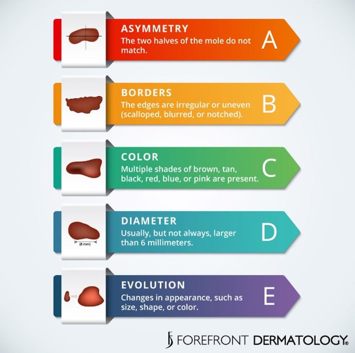 cancerous moles vs normal moles