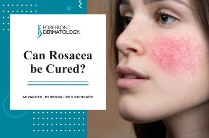 Can Rosacea Be Cured?| Forefront Dermatology