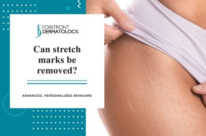 Can Stretch Marks Be Removed? | Forefront Dermatology