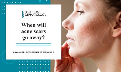 When Will Acne Scars Go Away?