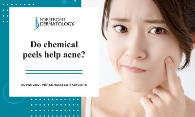 Do Chemical Peels Help Acne?
