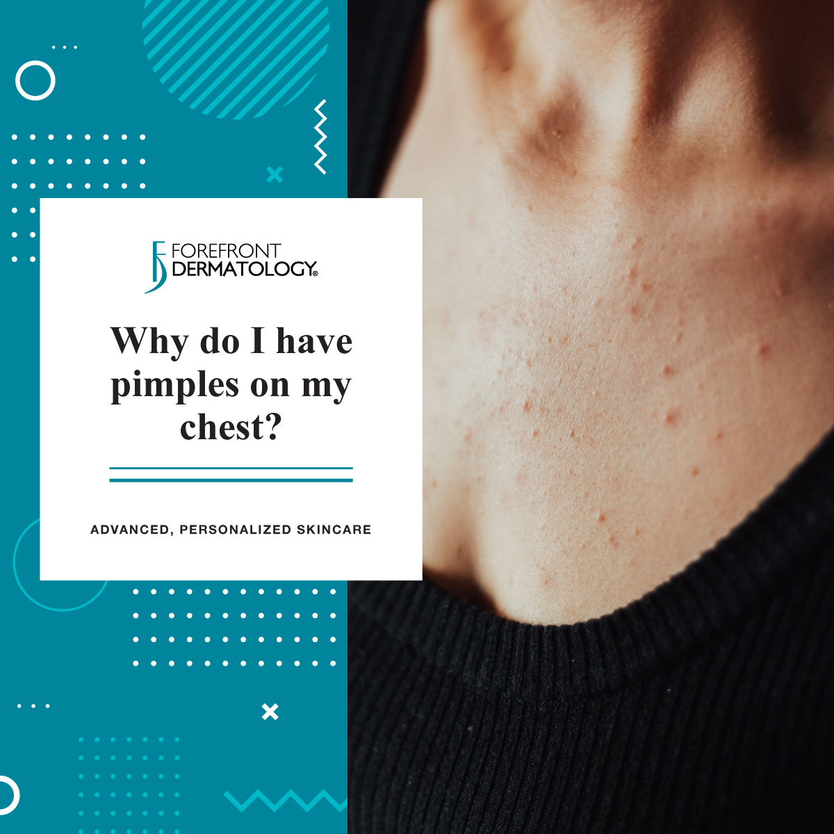 Why Do I Have Pimples On My Chest Forefront Dermatology