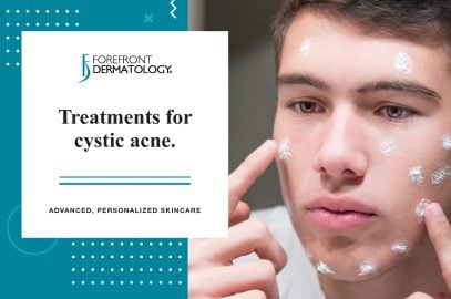 Treatments for Cystic Acne