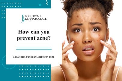 How to Prevent Acne