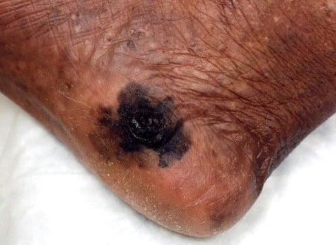 Skin Cancer in People of Color - Forefront Dermatology