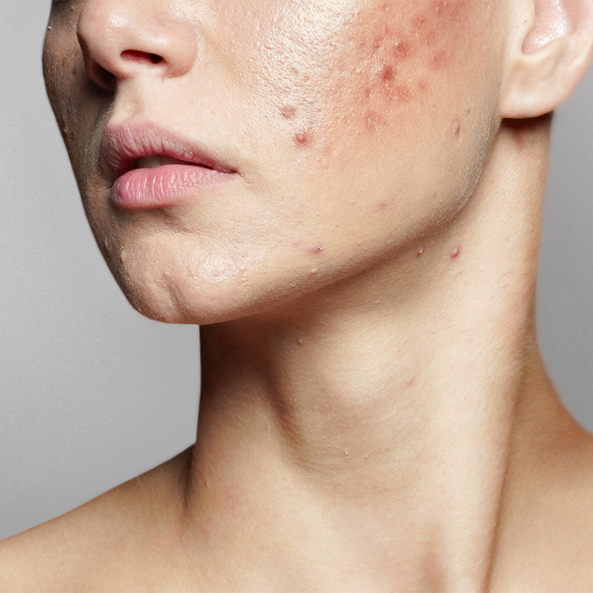 Can BBL Treatments Remove Acne Scars?, Blog