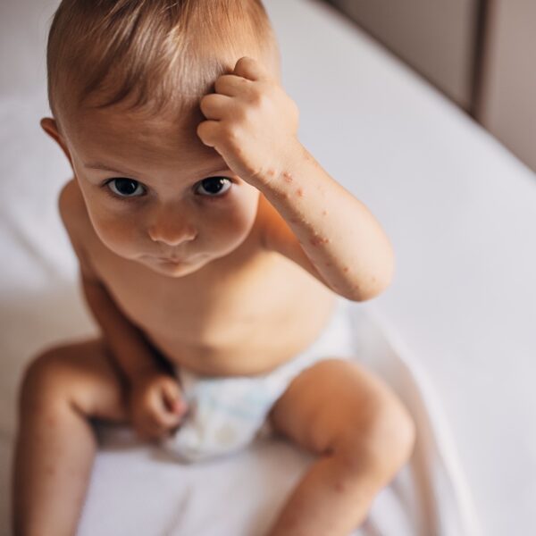 Hand-foot-and-mouth in Children and Adults