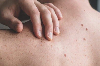 How Do You Know If You Have Skin Cancer?