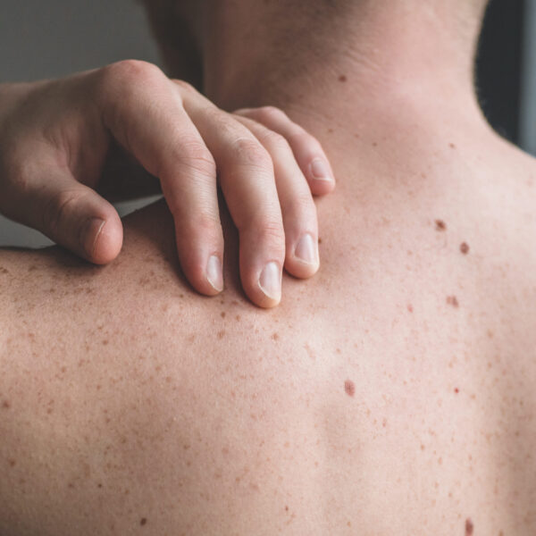 How Do You Know If You Have Skin Cancer?